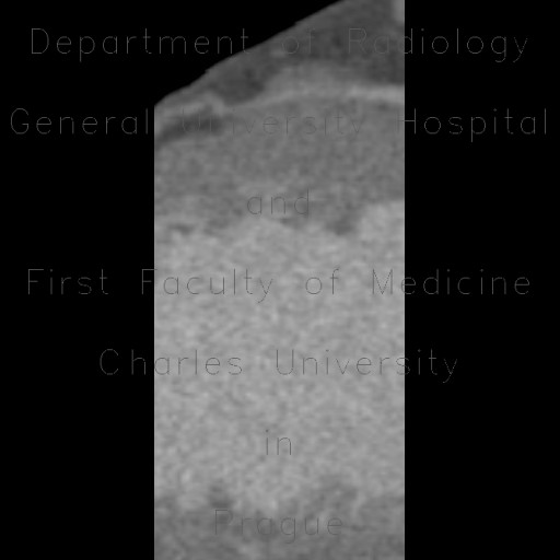 Myocardial bridging of LAD, left anterior descending artery