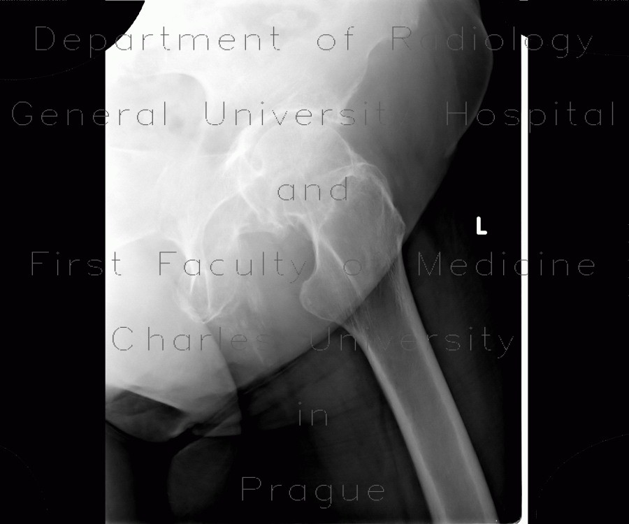 Myositis ossificans, ossifying tendon, adductor magnus, tuberosity of ischium