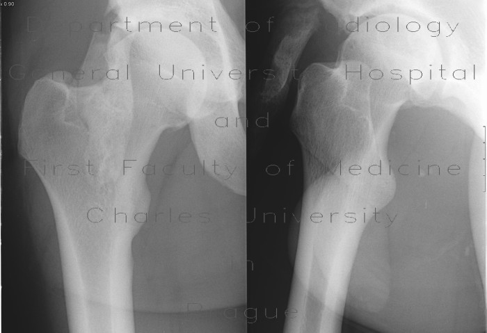 Radiology image - Myositis ossificans, soft tissue calcification: Extremity, Soft tissue: X-ray - Plain radiograph