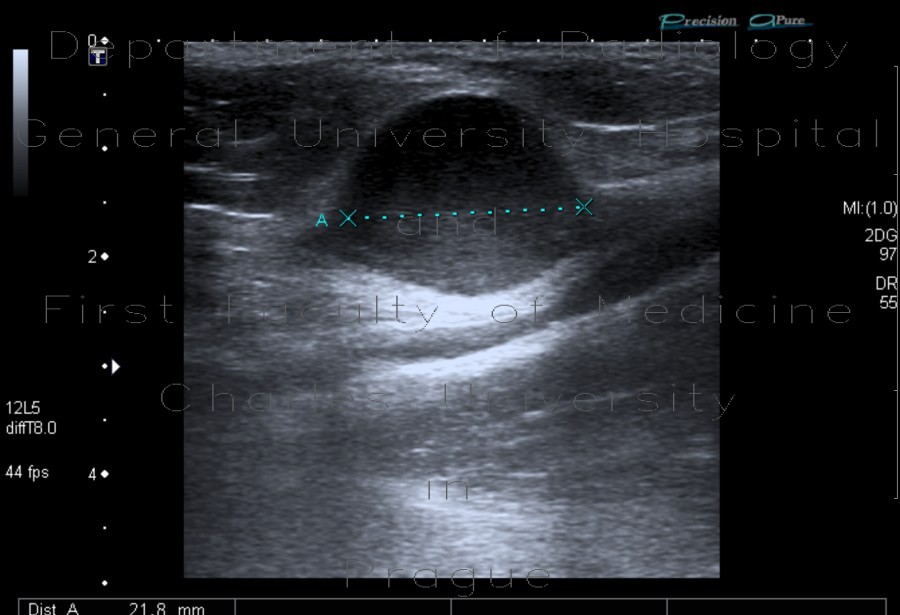 Myxofibrosarcoma of arm