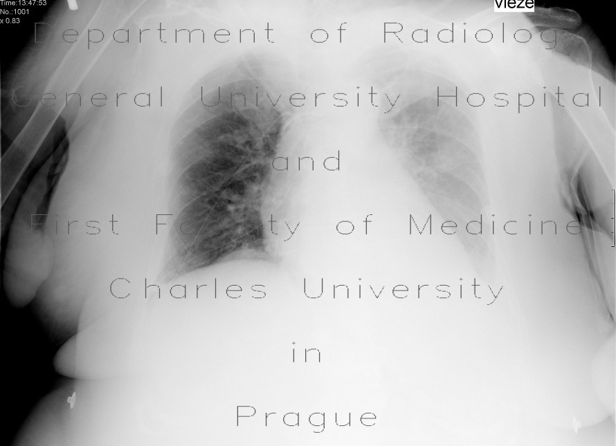Nasogastric tube in pleural cavity, pneumothorax, pleural effusion