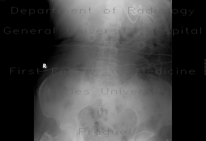 Nasojejunal tube, nasogastric tube