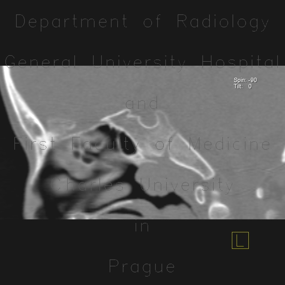 Nasopharyngeal tonsil, enlarged