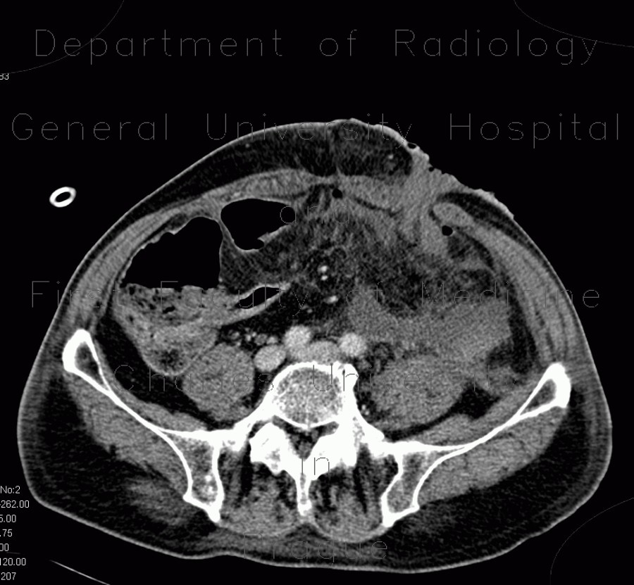 Necrosis of descending colon, colostomy