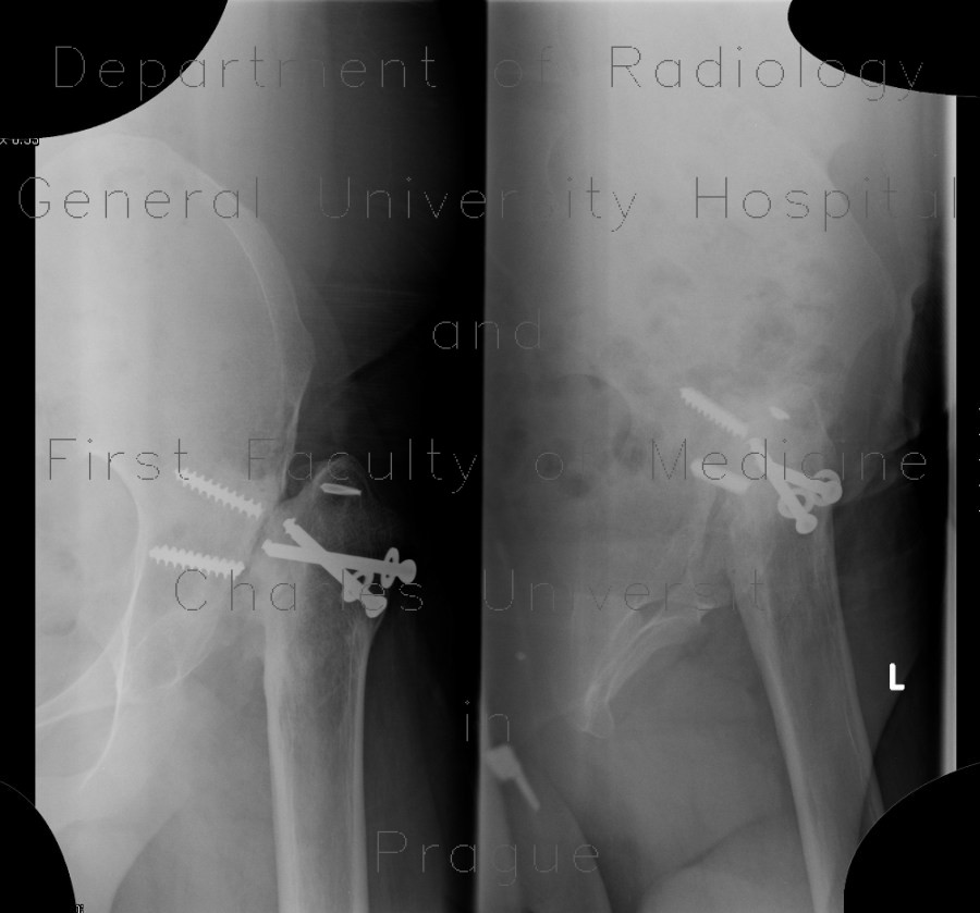 Necrosis of femoral head, osteonecrosis and hardware failure