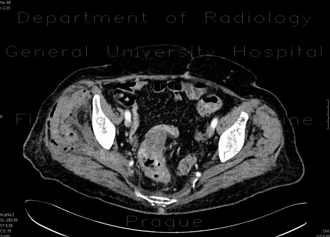 Radiology image - Necrotic tumor of rectosigmoid junction, fistulisation into thigh: Abdomen, Extremity, Large bowel, Soft tissue: CT - Computed tomography