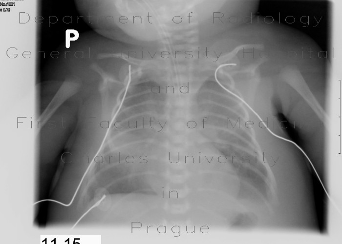 Radiology image - Neonatal lung, respiratory distress: Thorax, Lung: X-ray - Plain radiograph