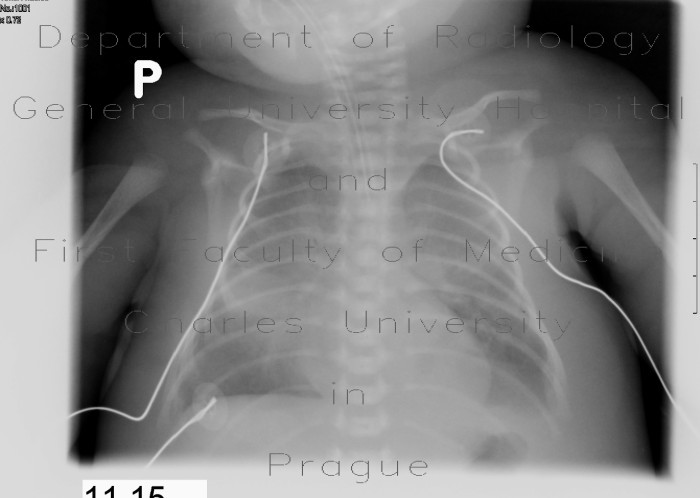 Neonatal lung, respiratory distress