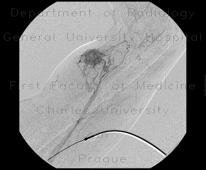 Neovascularisation in tumour of biceps brachii