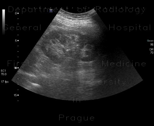 Nephrocalcinosis, calcification of papilla