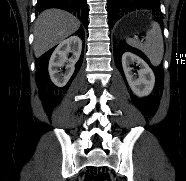 Nephrolithiasis