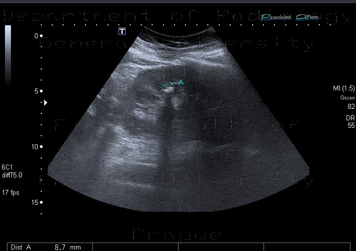 Radiology image - Nephrolithiasis, kidney stone: Abdomen, Kidney and adrenals: US - Ultrasound