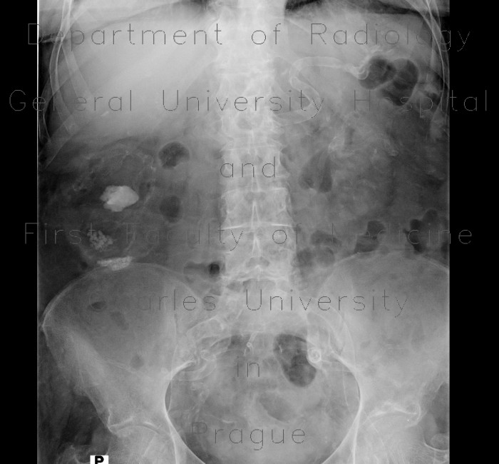 Nephrolithiasis, kidney stones, calcified splenic artery, Chinese dragon sign