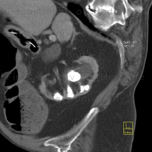 pyelonephritis x ray