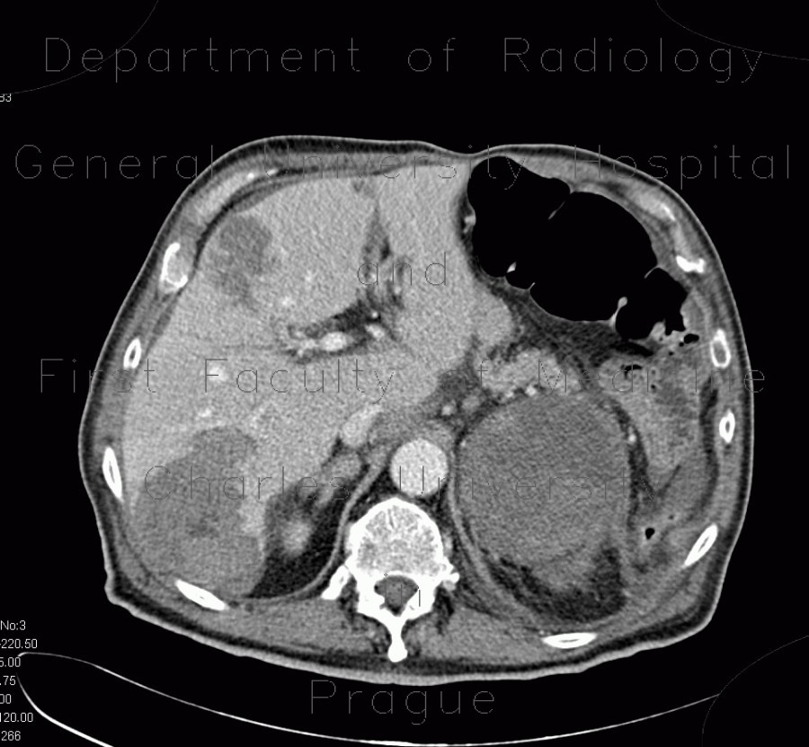 Neuroendocrine tumour of adrenal gland, liver metastasis, necrotic