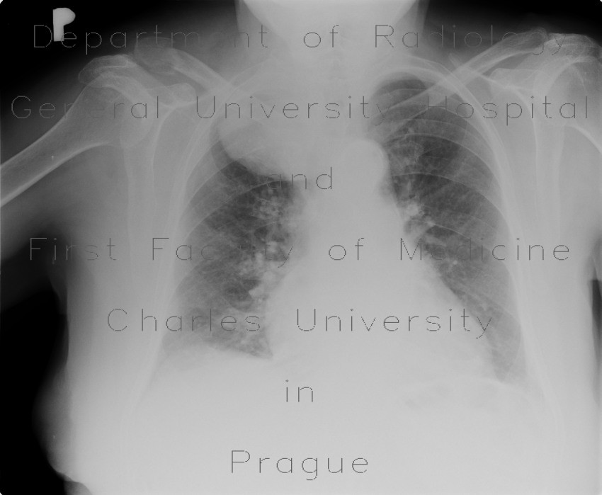 Radiology image - Neurofibroma of the thorax: Spine and Axial, Thorax, Soft tissue: X-ray - Plain radiograph