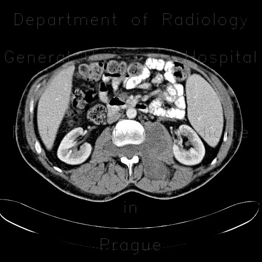 Radiology image - Neurofibromatosis, type I, von Recklinghausen disease, neurofibroma: Abdomen, Spine and Axial, Bone, Brain, Soft tissue: CT - Computed tomography