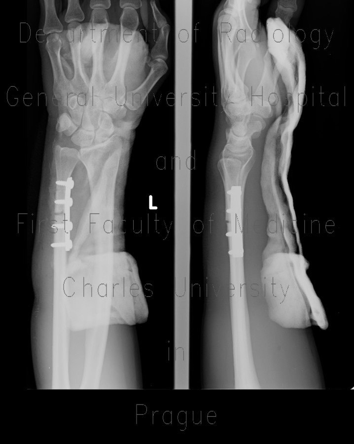 Radiology image - Non-union, fracture of ulna, shaft of distal ulna: Extremity, Bone: X-ray - Plain radiograph