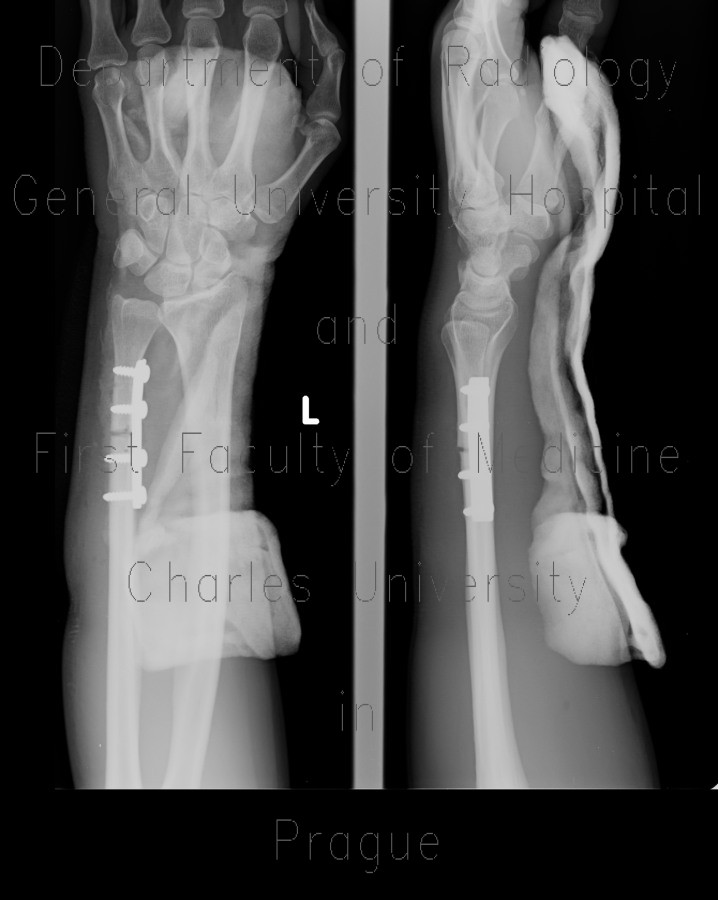 Non-union, fracture of ulna, shaft of distal ulna