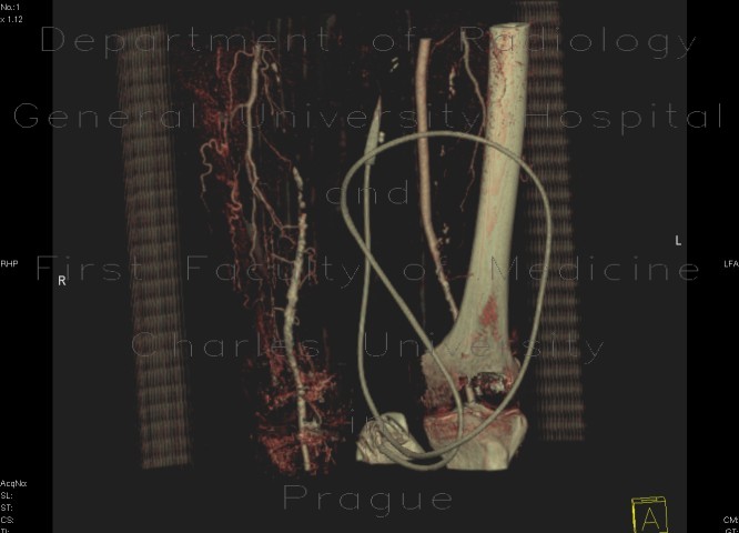 Obliterated right femoral artery and collateralisation, VRT