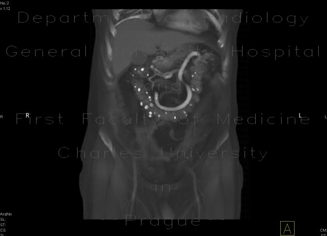 Obliteration of the coeliac trunk and superior mesenteric artery, massive collateral flow