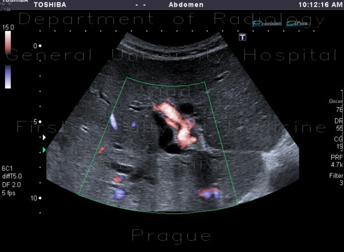 Obstruction of biliary stent, dilated intrahepatic biliary ducts