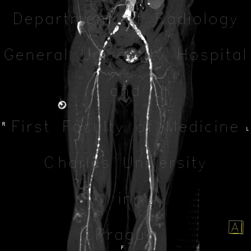 Radiology image - Occlusion of iliac artery, collateral blood flow: Abdomen, Extremity, Vessels: CT - Computed tomography
