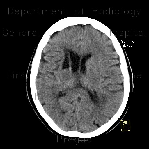 Occlusion of middle cerebral artery, MCA, collateral flow, postischemic changes