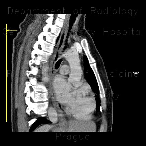 Radiology image - Oesophagitis, corrosive oesophagitis, lye ingestion, CPR: Thorax, Oesophagus: CT - Computed tomography