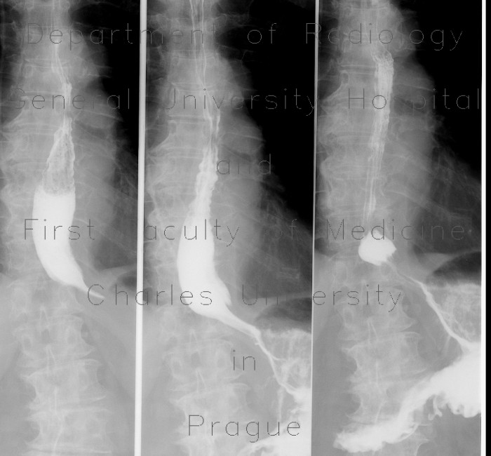 Oesophagitis, transpyloric prolapse