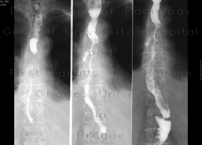 Oesophagus tumor, recurrence, fistulae