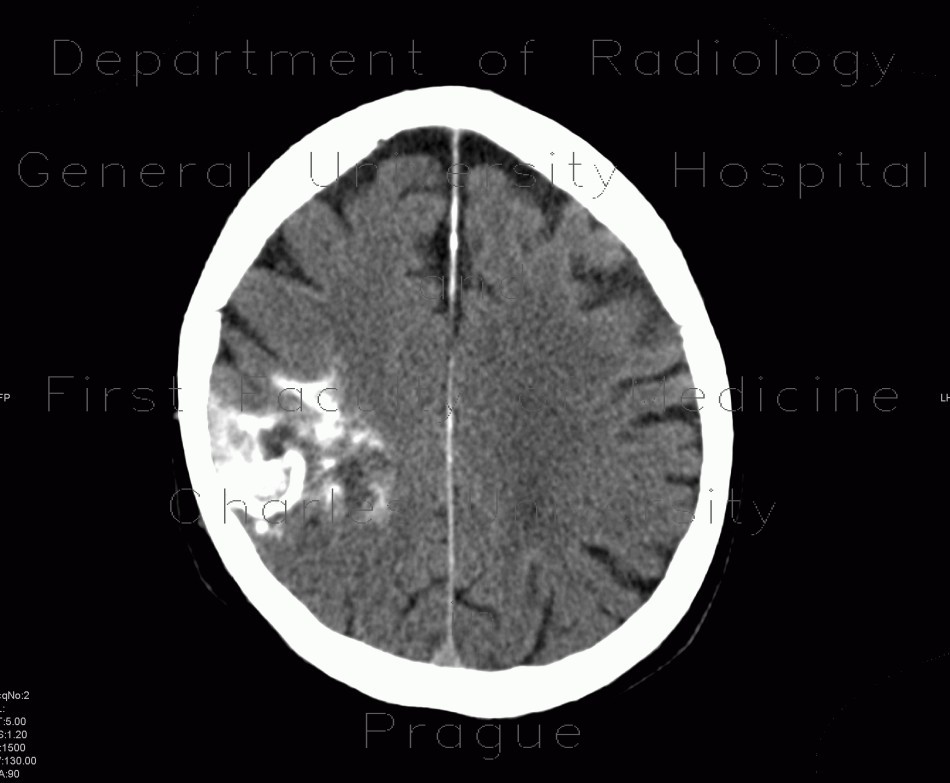 Oligodendroglioma of parietal lobe