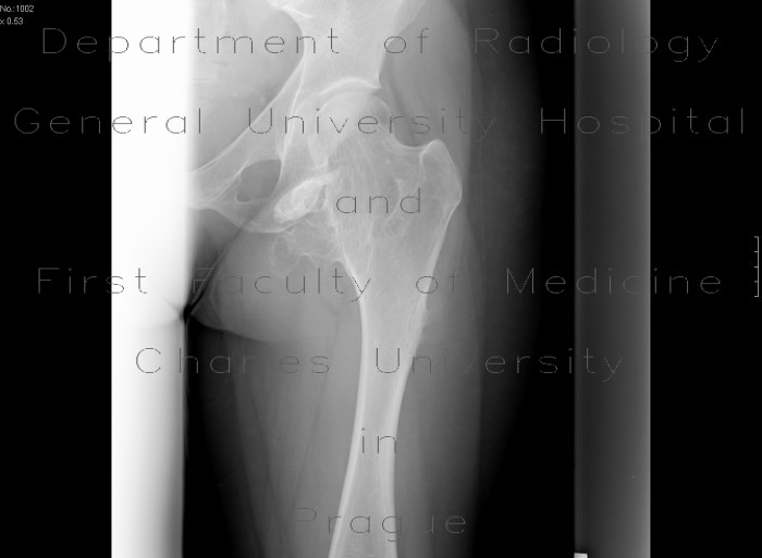 Radiology image - Ollier