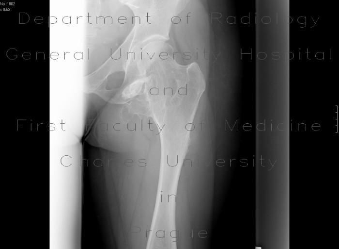 Ollier's disease, enchondromatosis