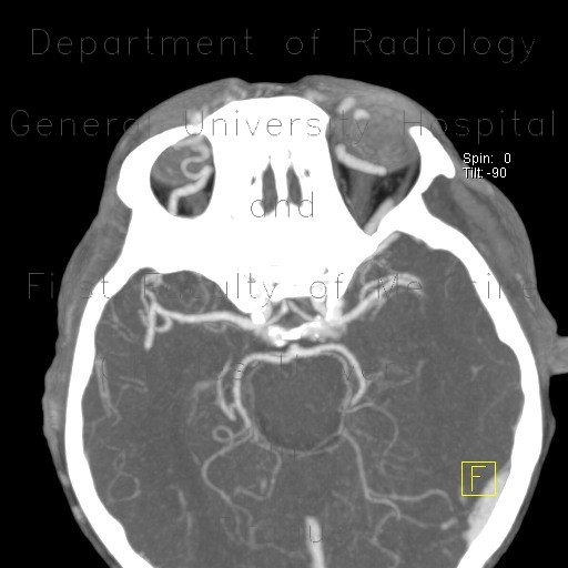 Ophthalmic artery, dilated