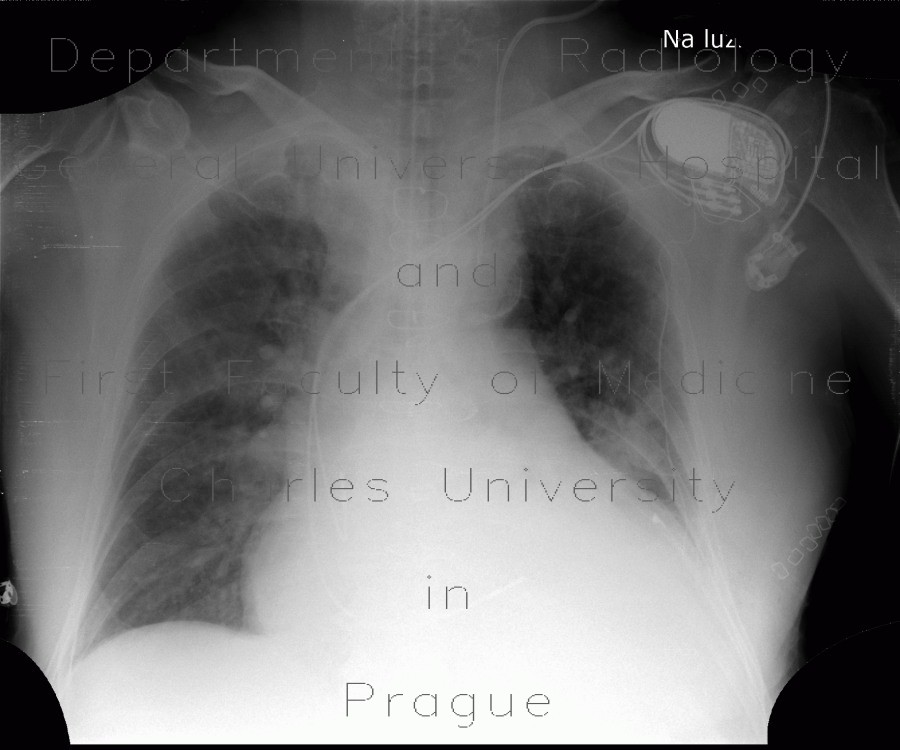 Radiology image - Orotracheal tube, biluminal, intubation: Thorax, Lung, Other: X-ray - Plain radiograph