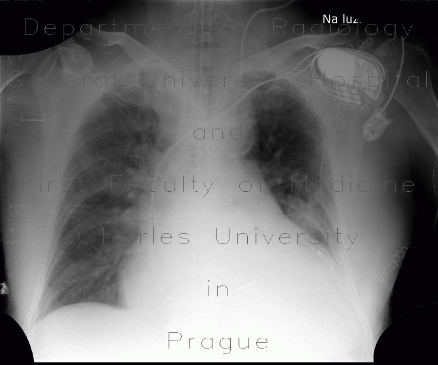 Orotracheal tube, biluminal, intubation