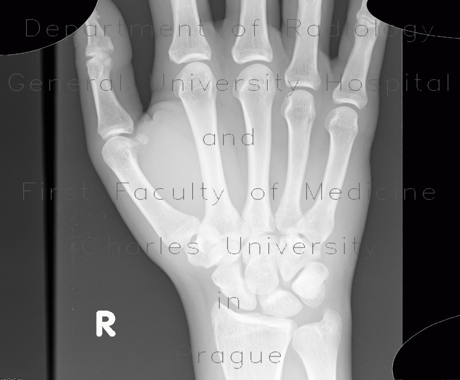 Os epipyramis, accessory bone