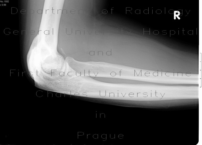 Osseous bridging of the left elbow