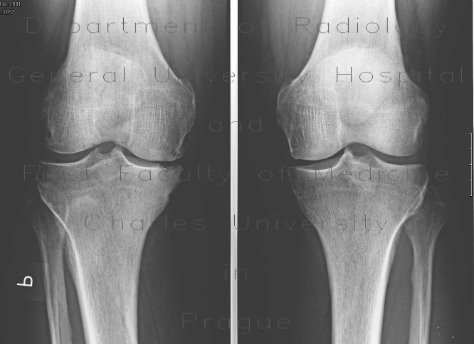 Radiology image - Osteochondritis dissecans: Extremity, Bone: X-ray - Plain radiograph