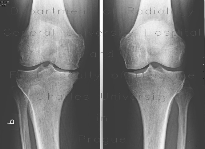 Osteochondritis dissecans