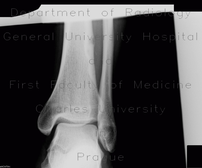 Radiology image - Osteoid osteoma: Extremity, Bone: X-ray - Plain radiograph