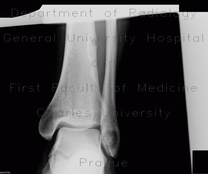 Osteoid osteoma