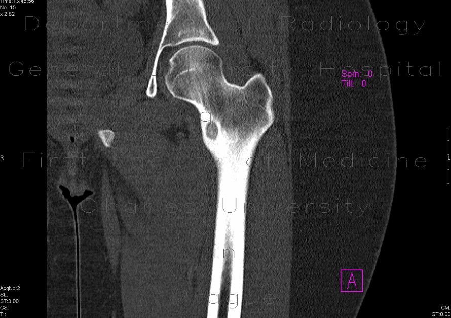 Radiology image - Osteoid osteoma: Extremity, Bone: CT - Computed tomography