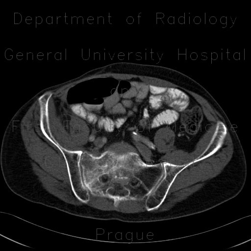 Radiology image - Osteolysis of sacrum: Spine and Axial, Bone: CT - Computed tomography