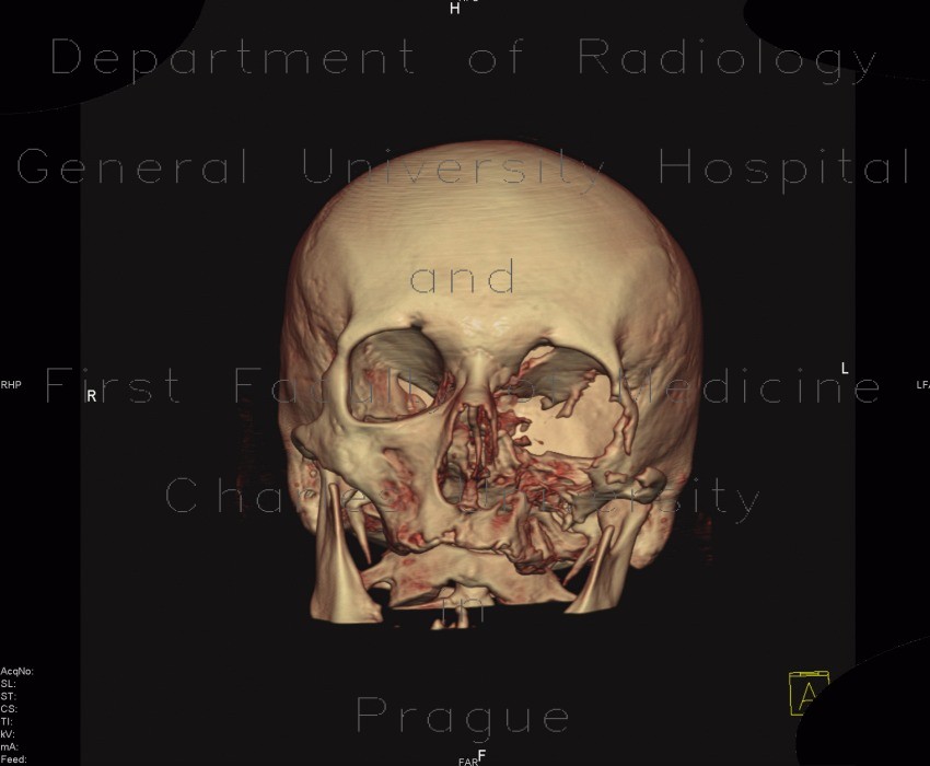 Osteolytic changes of facial skeleton