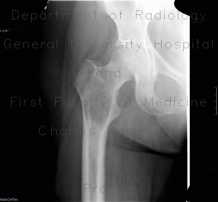 Osteolytic changes of femur