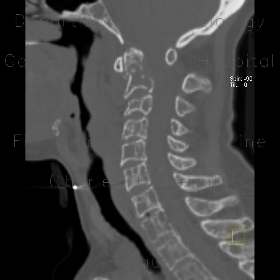 Radiology image - Osteolytic metastasis of cervical spine, fracture of dens axis, C2: Spine and Axial, Bone: CT - Computed tomography