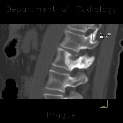 Osteolytic metastasis of pedicle