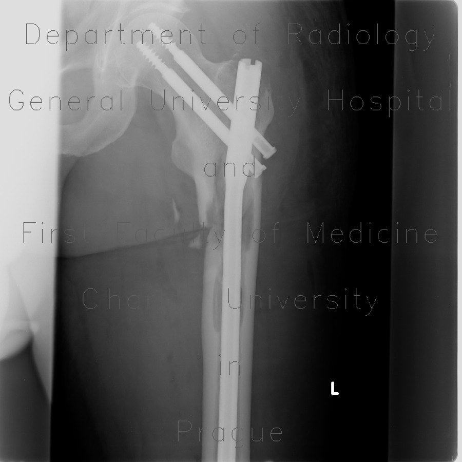 Osteolytic metastasis, pathological fracture of femur, osteosynthesis